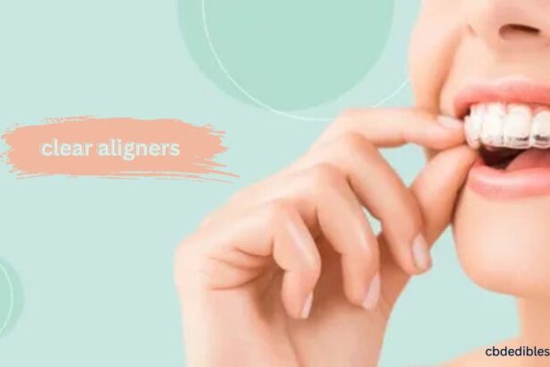 clear aligners